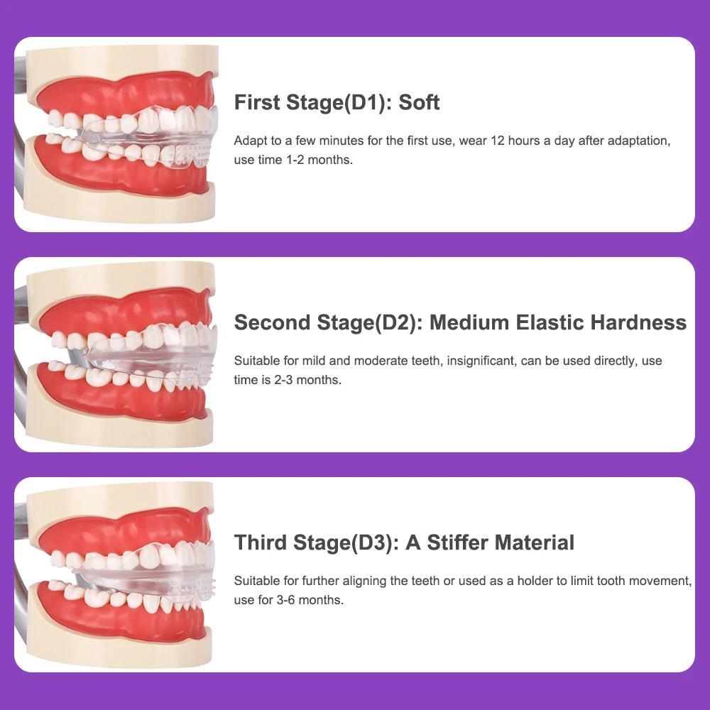 Appareil dentaire, accolades orthodontiques, entraîneur de dents, entraîneur d'alignement, embout po