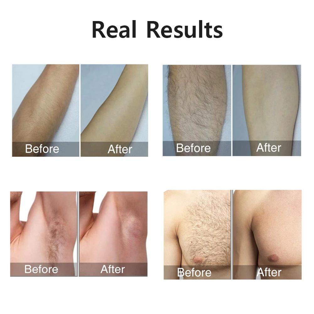999999   Flashes épilateur Laser pour femmes hommes corps Bikini jambes bras aisselles épilation ind