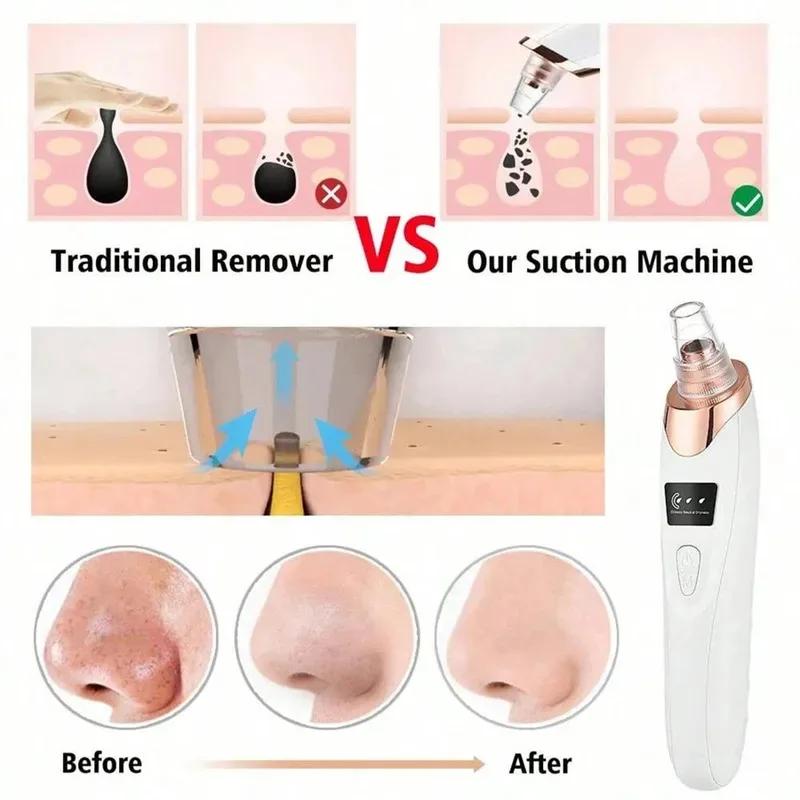 Nettoyeur électrique pour le soin de la peau du visage, élimination des pores, aspirateur pour l'éli