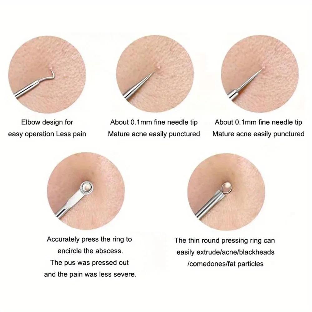 Kit d'extraction d'imperfections de boutons et d'acné, points noirs, aiguilles en acier inoxydable,