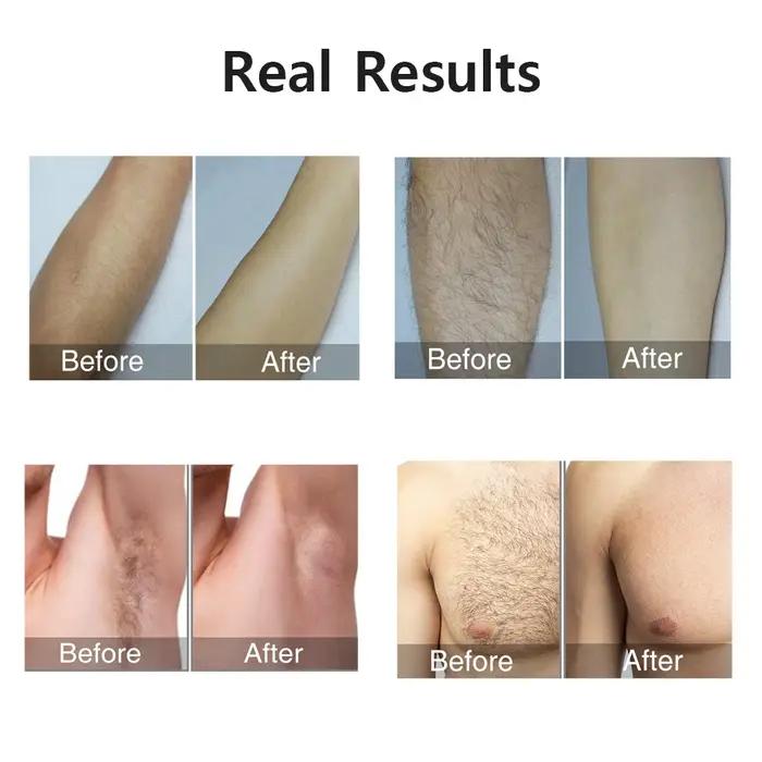 999999 Flashes épilateur Laser pour femmes hommes corps Bikini jambes bras aisselles épilation ind