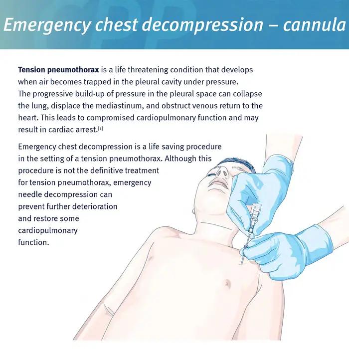 Sanke sauvetage pneumothorax aiguille traumatisme médical Ifak cathéter de poitrine aiguille 50g aig